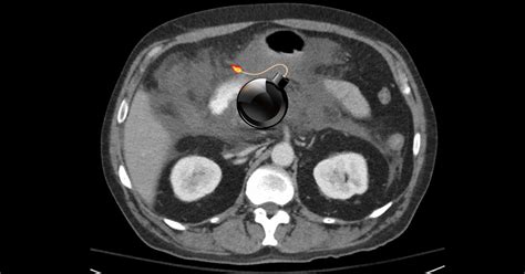 Hypertriglyceridemic pancreatitis: Can we defuse the bomb? – Critical ...