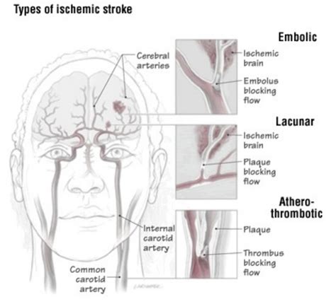 56 Amazing What Is Lacunar Syndrome - insectza