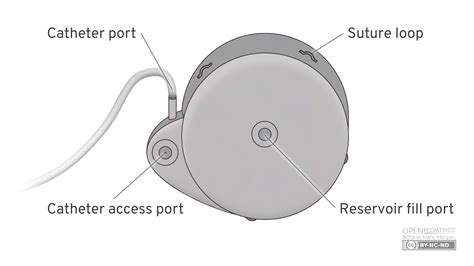 Baclofen pump and its components