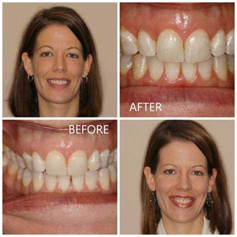 ClearCorrect at Elenberger Orthodontics | Orthodontics, Traditional braces, Orthodontist