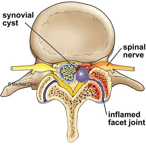 Evan's story, Synovial cyst | Mayfield Brain & Spine