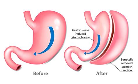 Gastrectomía en Manga Laparoscópica - New Life Bariatric