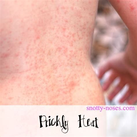 Causes of roseola in toddlers signs treatment prevention – Artofit