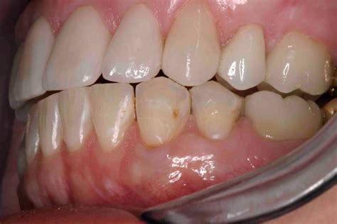 Incisal Embrasures: More Than A Pretty Smile - Lee Ann Brady DMD