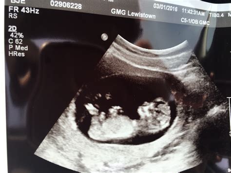 12 week ultrasound! Boy or girl?! Please help!!