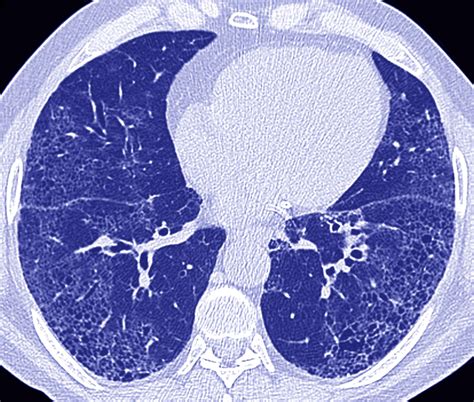 Comparing Mortality Risks Between Idiopathic Pulmonary Fibrosis Treatments - Pulmonology Advisor ...