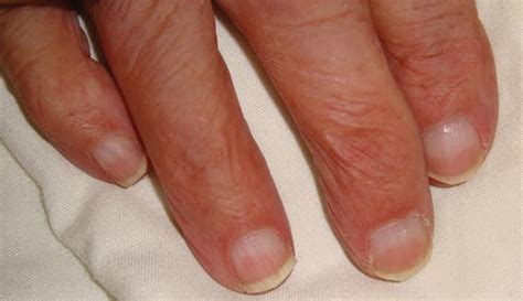 Lindsay nails • LITFL • Medical Eponym Library