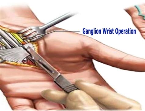 Ganglion Knee and Wrist Cyst Treatments - G-Relief Caps