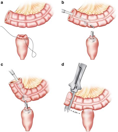 Anastomotic Construction | SpringerLink