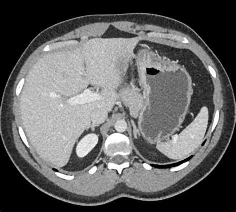 Adenocarcinoma: Gastric Adenocarcinoma Staging