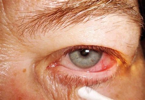 Trichiasis, distichiasis, aberrant lashes | Dr Graziani