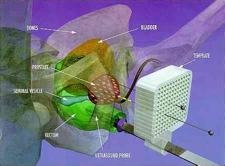 Prostate Surgery