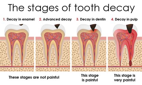 What Causes Tooth Decay and How to Treat It | Helpful Tips