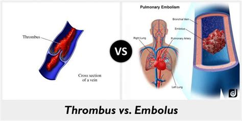 Thrombosis vs embolism - MEDizzy