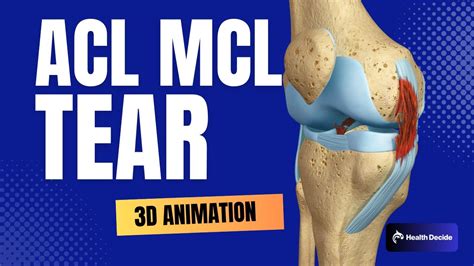 ACL and MCL Tear and Surgical Repair - 3D Animation - YouTube