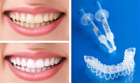 blanqueamiento-dental-casero-con-ferulas | Odontologists