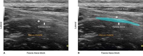 Fascia Iliaca Block Surface Anatomy