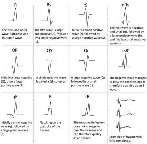 Pin by Alice Boxall on Medicine | Ecg interpretation, Ekg rhythms, Ekg interpretation