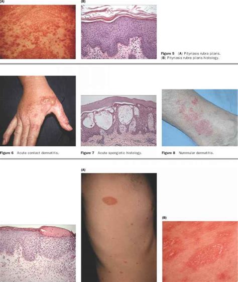 Impetigo Oathology - Dermatopathology - Mussen Healthcare