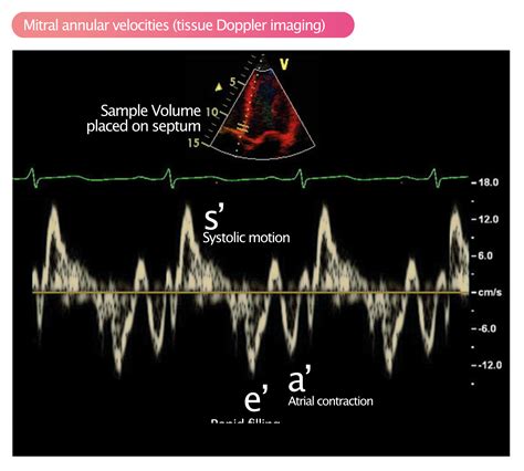 Assessment of diastolic function by echocardiography – Cardiovascular Education