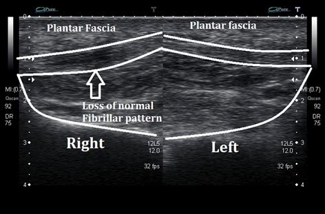 Plantar fascia tear/ Strain - Ankle, Foot and Orthotic Centre