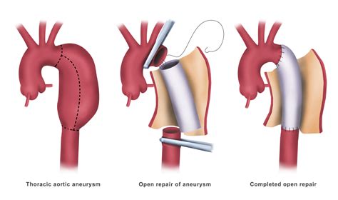 Normal Aortic Aortic Aneurysm Aortic Dissection Kardi - vrogue.co