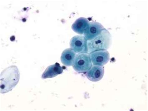 Atypical Urothelial Cells Indeterminate for Neoplasia - Urothelial Cells