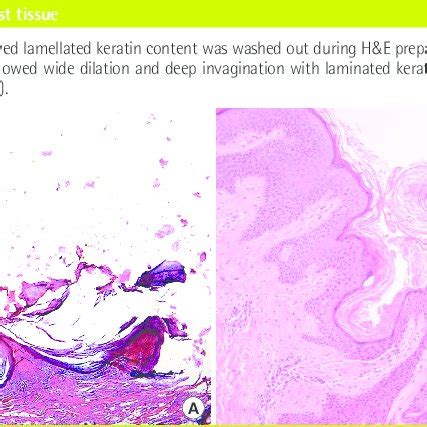 Histopathologic findings of cyst tissue | Download Scientific Diagram