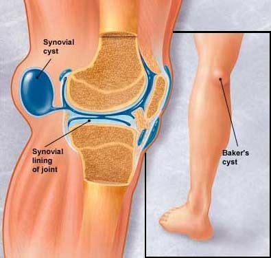 Baker's Cyst - Lump Behind the Knee by Dr Kevin Yip | Singapore Sports Clinic