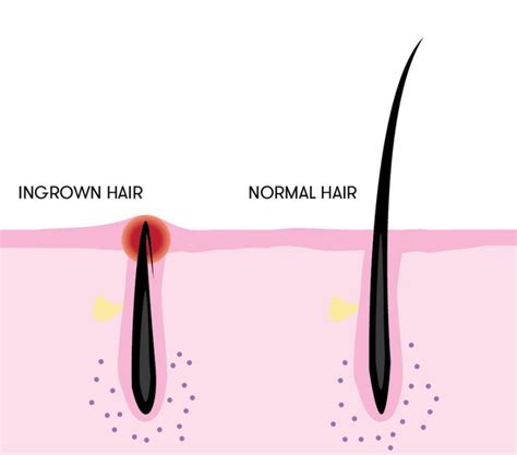 Joe Black Barbershop: Treating Ingrown Facial Hairs - Joe Black Barbershop