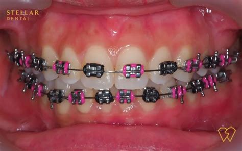 Braces Colors: Top Picks For 2023 - Stellar Dental