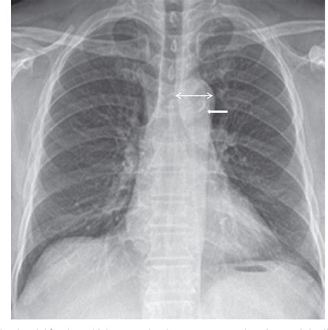 Table 1 from The clinical significance of aortic calcification in chest ...