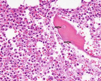 Pathologic Diagnosis of Osteomyelitis | Musculoskeletal Key