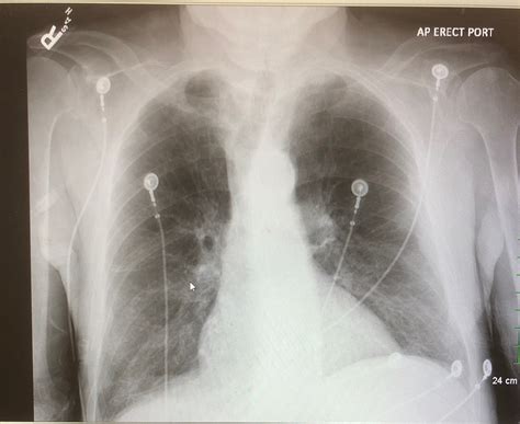 Cureus | Thrombocytopenia: A Diagnostic Dilemma and Incidental Detection of Systemic Lupus ...