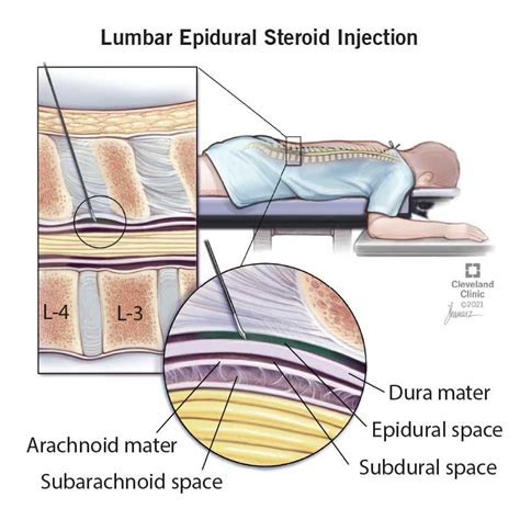 Epidural side effects – Artofit