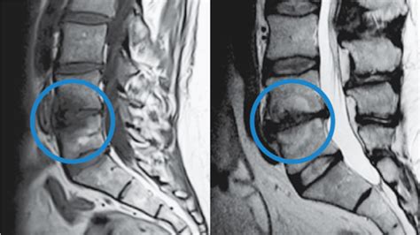 Modic Changes - The Intracept Procedure by Relievant