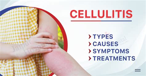 Cellulitis: Types, Causes, Symptoms, and Treatments