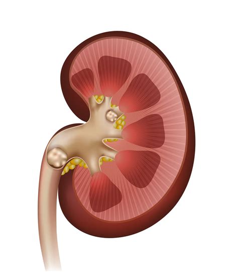 Kidney Stones | Chattanooga, TN | UT Urology - UT Erlanger Urology