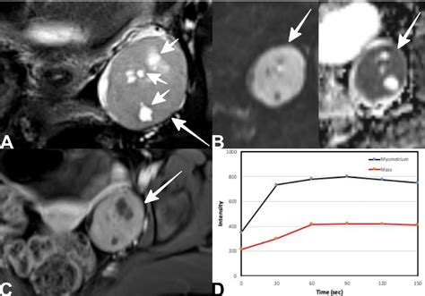 Diagnostic accuracy and validity of the O-RADS MRI score based on a simplified MRI protocol: a ...