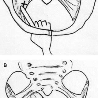 Published outcomes of sacrospinous ligament fixation for POP. | Download Table