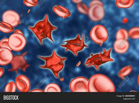 Acanthocytes, Abnormal Image & Photo (Free Trial) | Bigstock