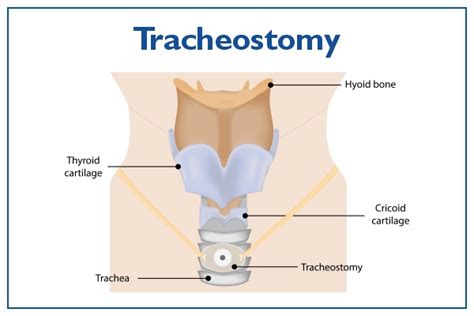 Tracheostomy Procedure Anatomy