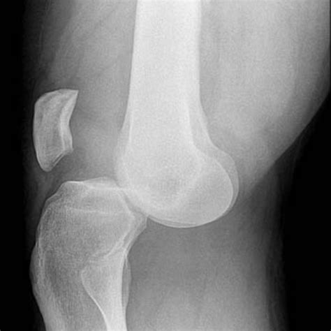 Podcast #148: Knee Dislocation - The Emergency Medical Minute