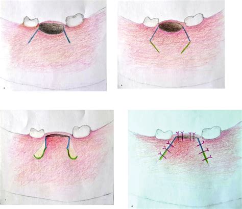 Schematic view of the "back-cut technique". (a) Trapezoid flap ...