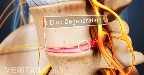 Lumbar Degenerative Disc Disease: Overview, Causes, and Symptoms