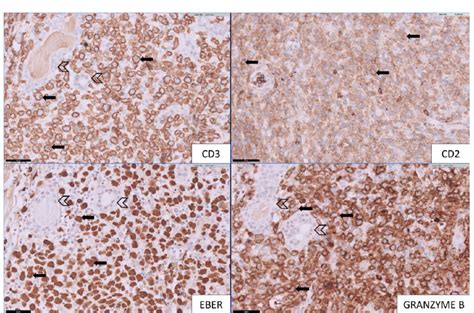 [Top left] Medium to large lymphomatous cells show cytoplasmic staining... | Download Scientific ...