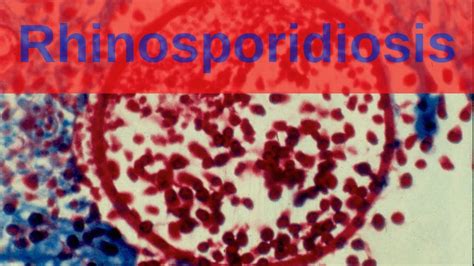 Rhinosporidiosis - Pathology mini tutorial - YouTube