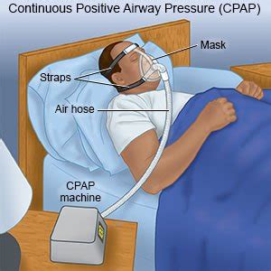 What is a CPAP Machine, Benefits, Usage Tips - Drugs.com