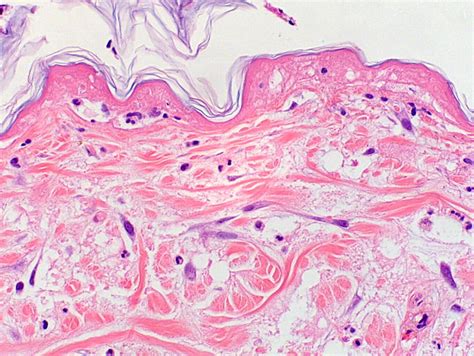 Effects of loxoscelism on skin. Extensive coagulation necrosis of... | Download Scientific Diagram