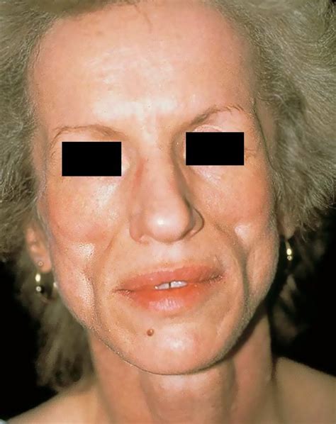 Lipodystrophy - Pictures, Symptoms, Causes, Treatment